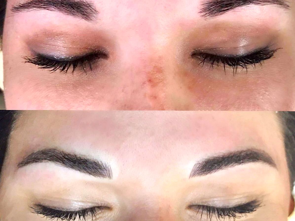 Are Peeling Eyebrows Common After Microblading?